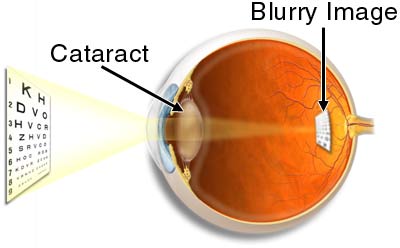 Cataracts