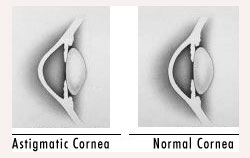 Astigmatism